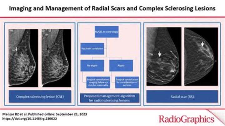 All radial scars/complex sclerosing lesions seen on breast screening mammograms should be excised - ePrints