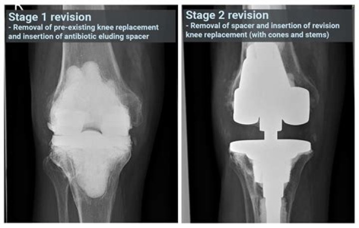 Can we define envelope of laxity during navigated knee arthroplasty? - ePrints