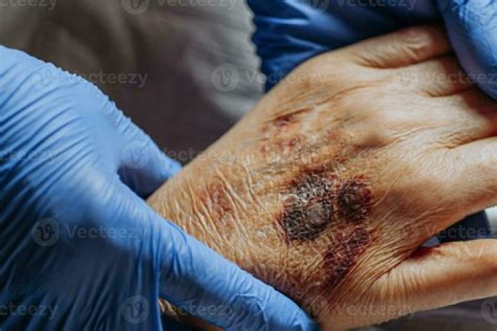 Hands and arms covered in bruises!