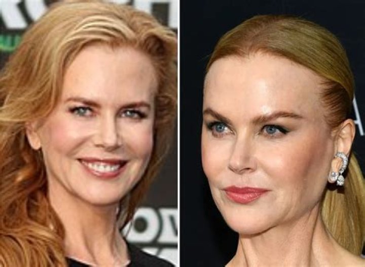 How Much Plastic Surgery Did Nicole Kidman Have?