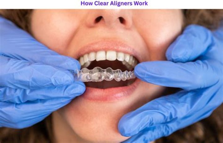 Revolutionizing Dental Care: The Rise of Clear Aligners